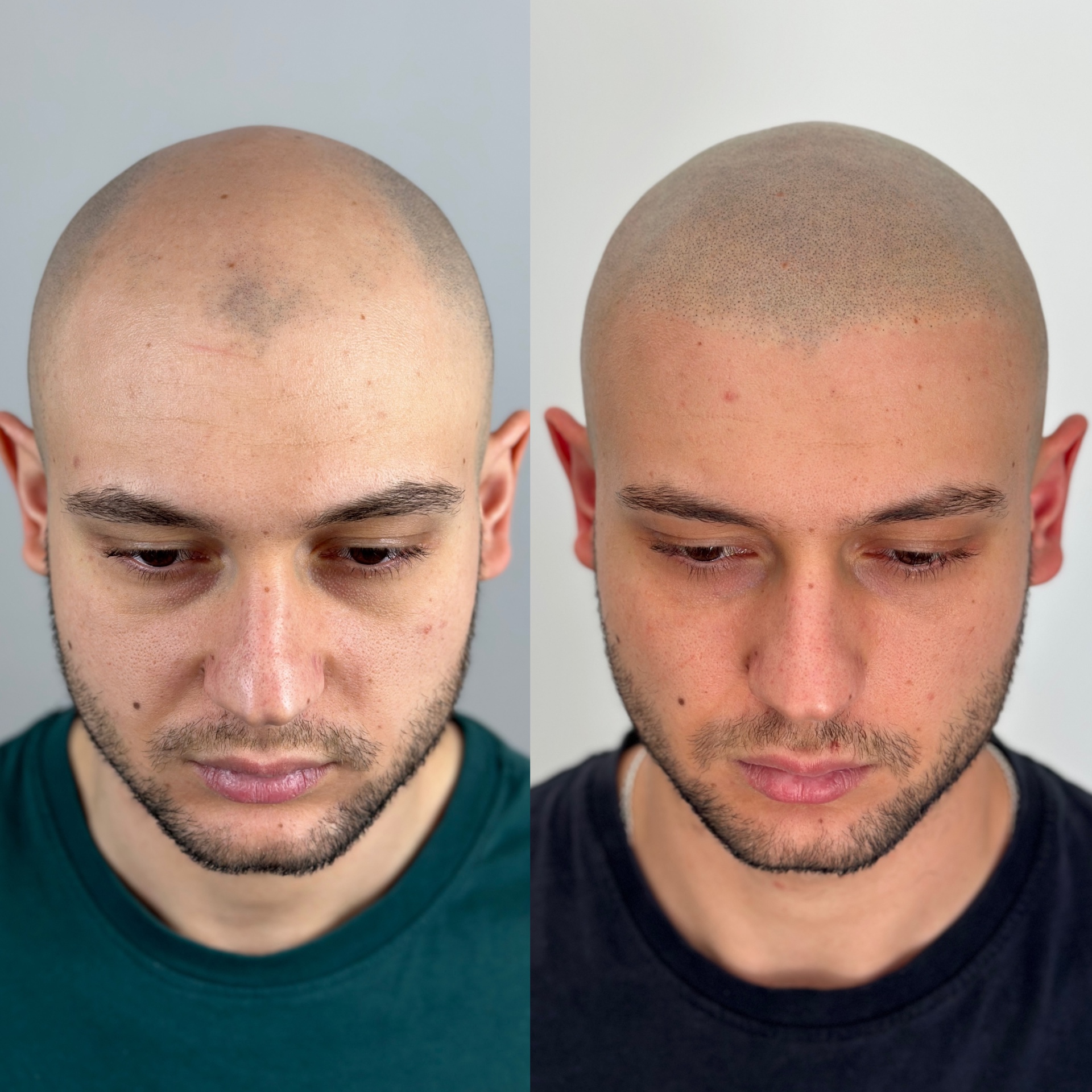 SMP before and after result