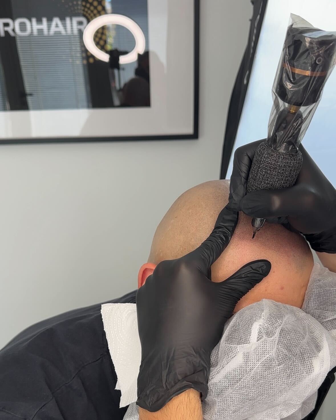 SMP procedure in progress at the MICROHAIR studio
